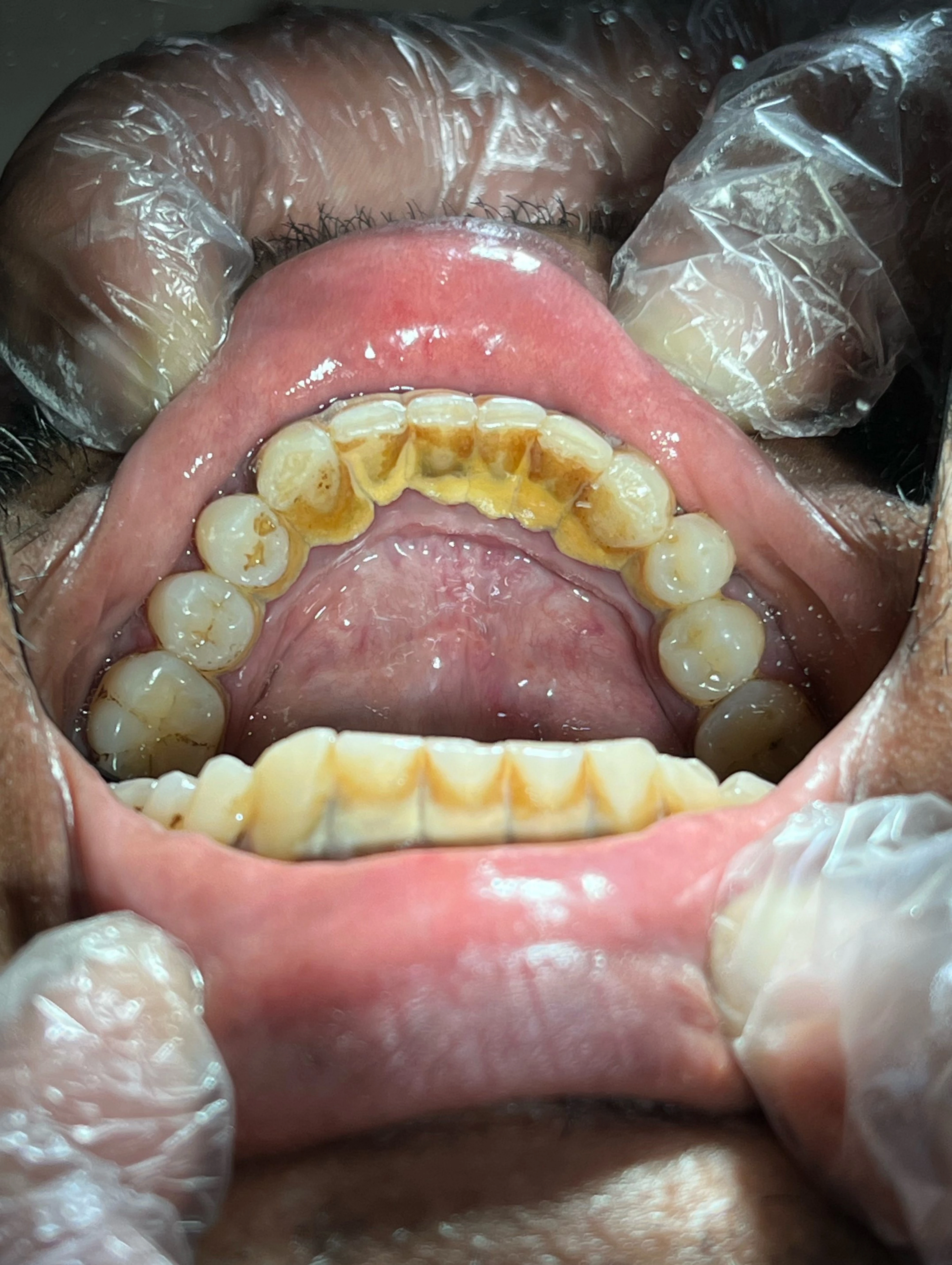 What is Scaling & Polishing? Benefits, Procedure & Cost in Pakistan — image 1