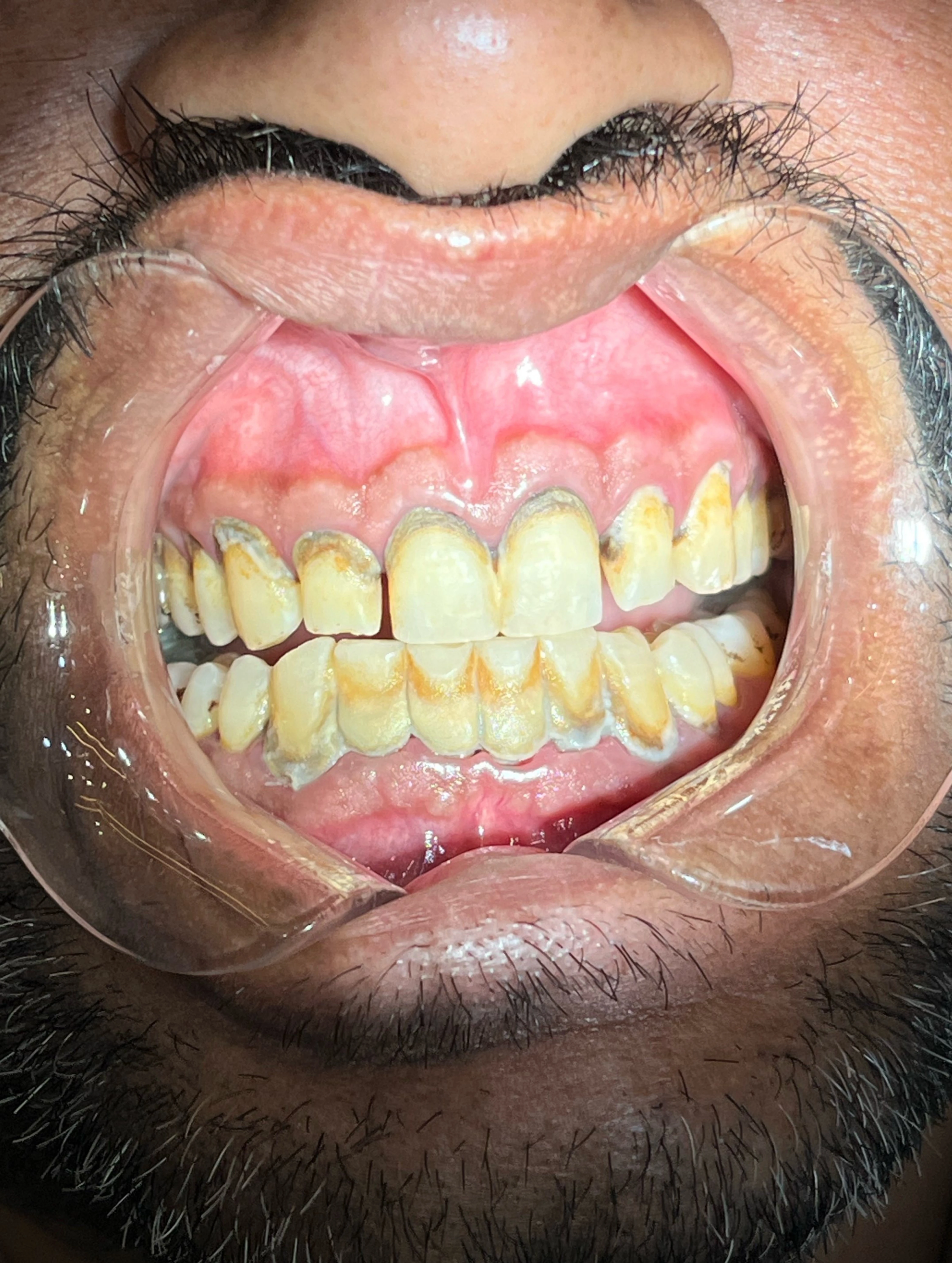 What is Scaling & Polishing? Benefits, Procedure & Cost in Pakistan — image 2