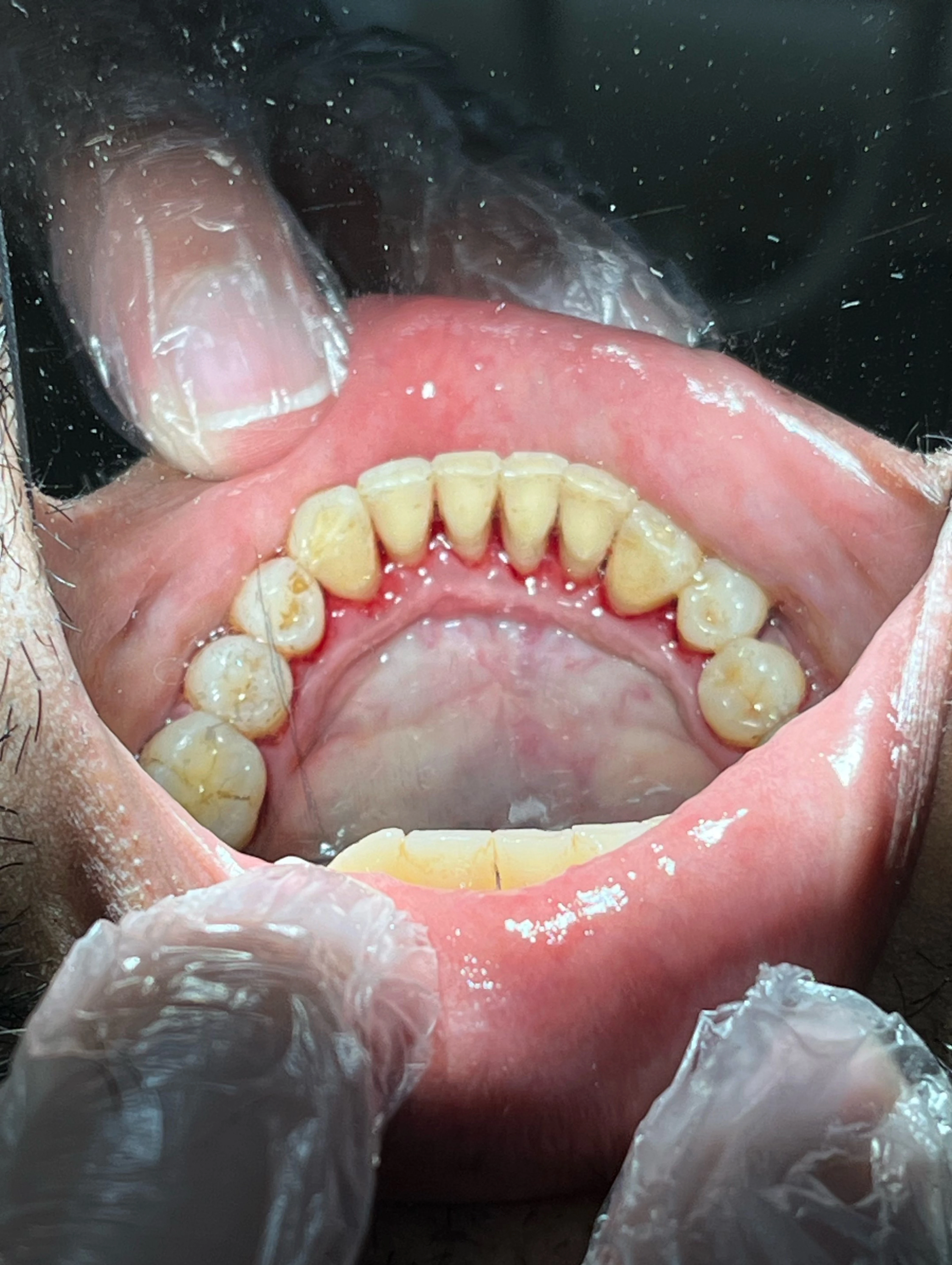 What is Scaling & Polishing? Benefits, Procedure & Cost in Pakistan — image 3