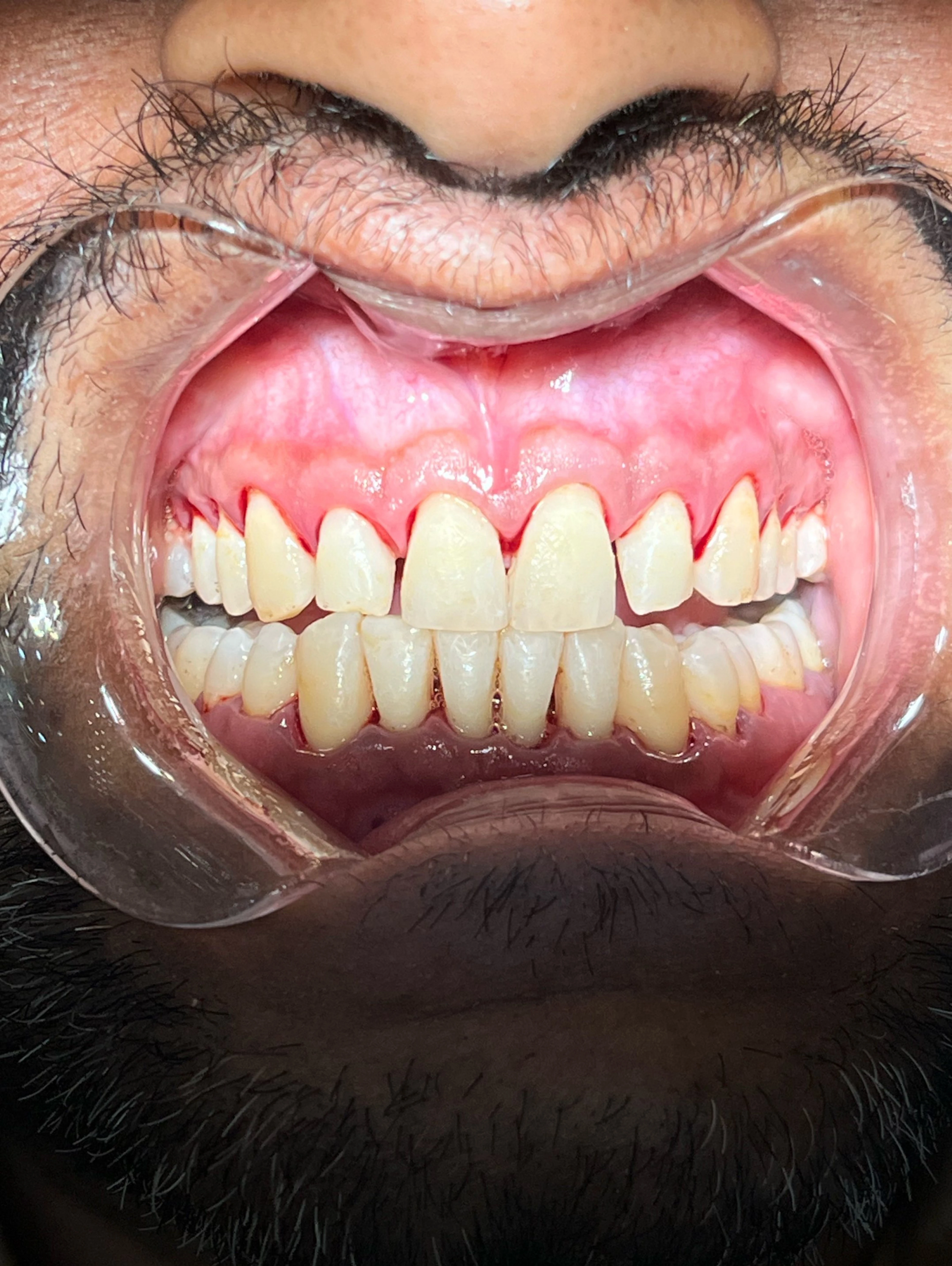 What is Scaling & Polishing? Benefits, Procedure & Cost in Pakistan — image 4