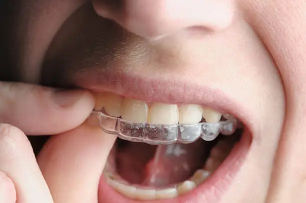 Aligners