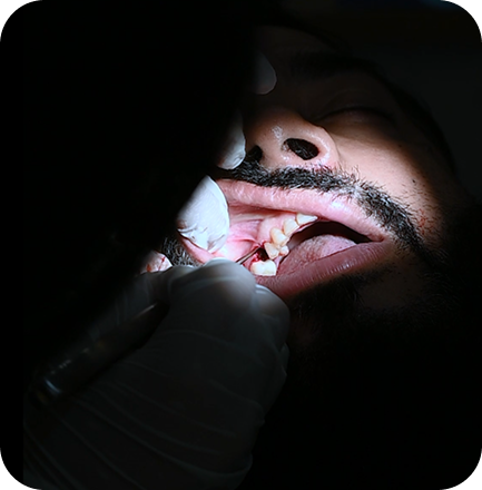 Root Canal