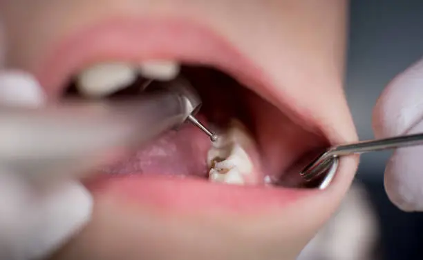 Dental Filling
