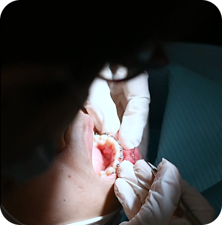 Root Canal