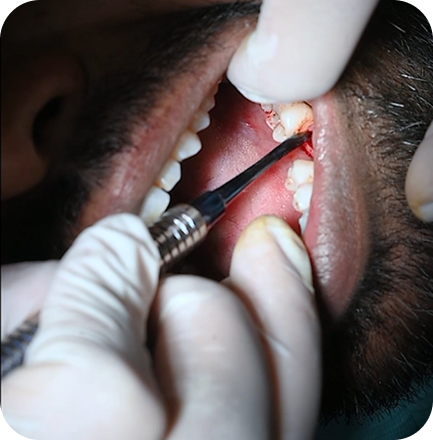 Root Canal