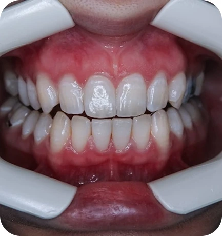 The whitening process