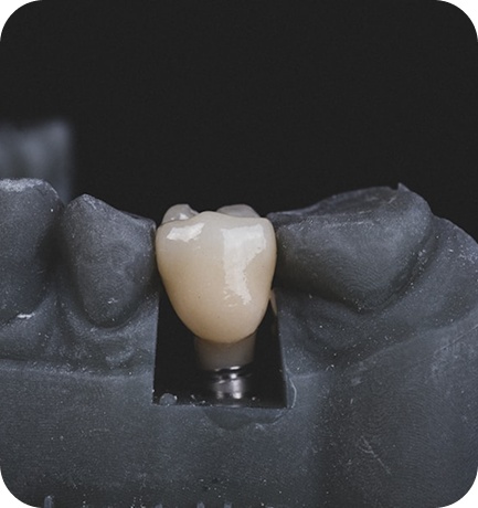 The aligner treatment process