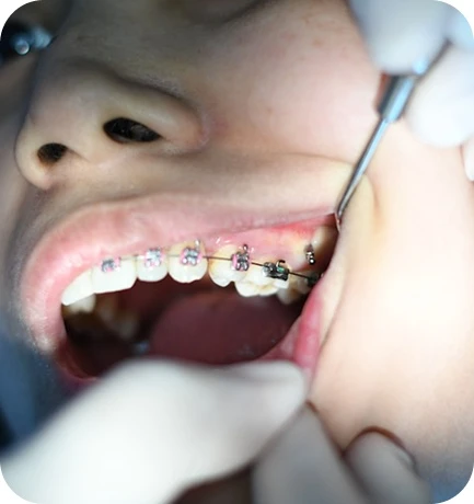 The braces process