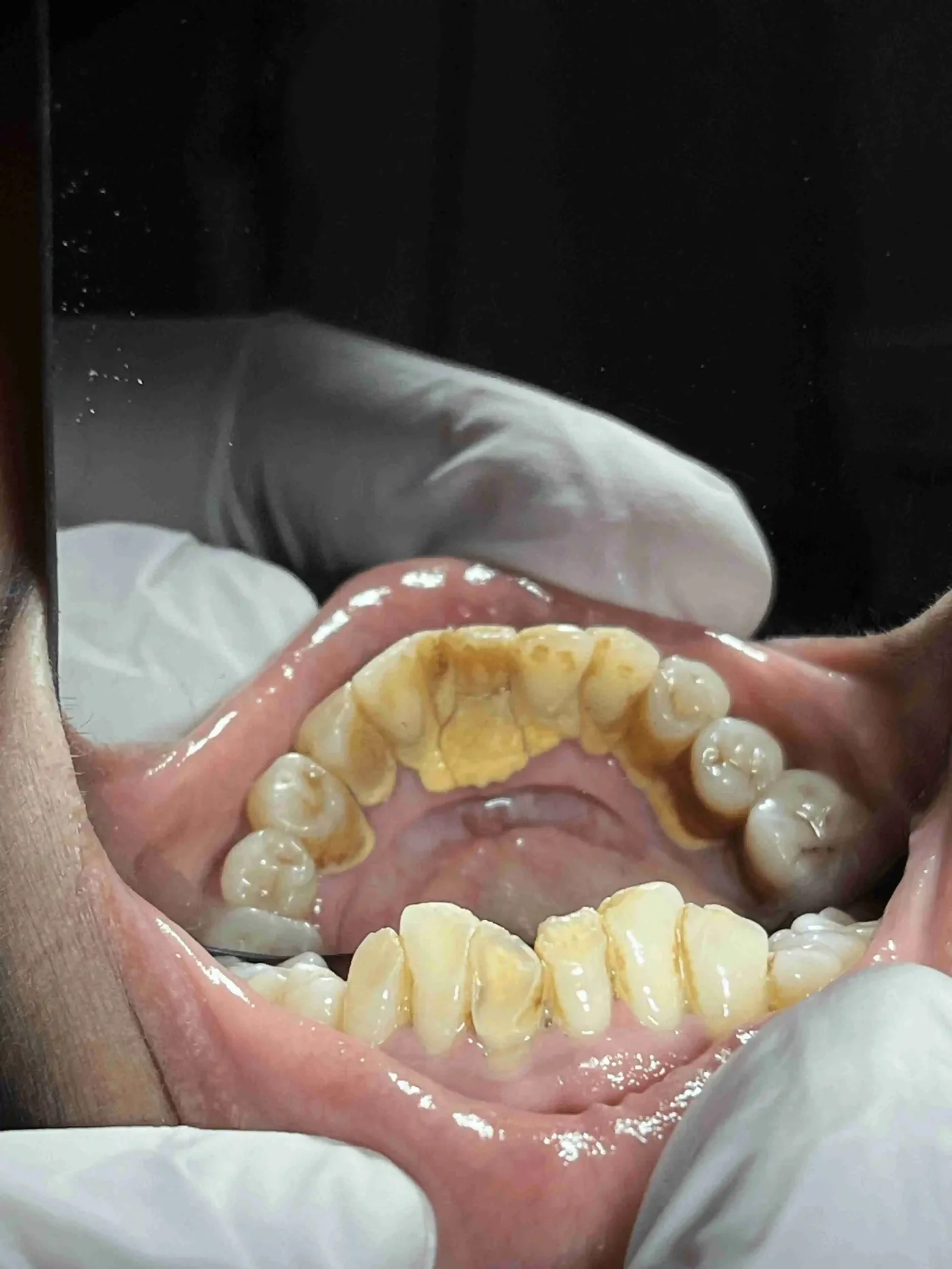 Before scaling: thick yellow tartar on the inner surfaces of the lower front teeth
