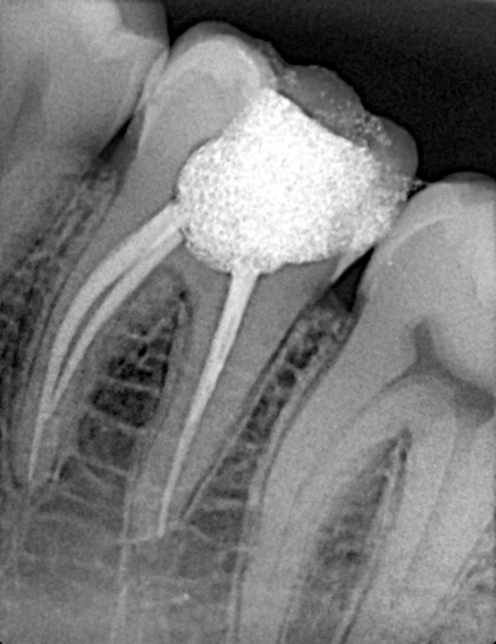 Root Canal Cost in Gujranwala: Complete 2026 Price Guide — image 4