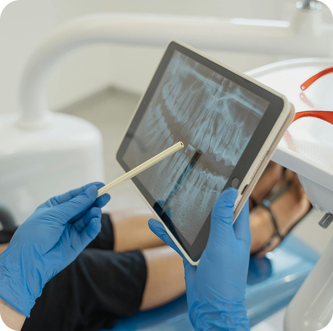 The root canal process