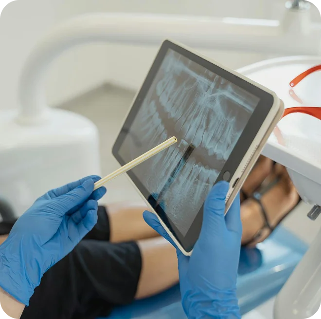 The root canal process