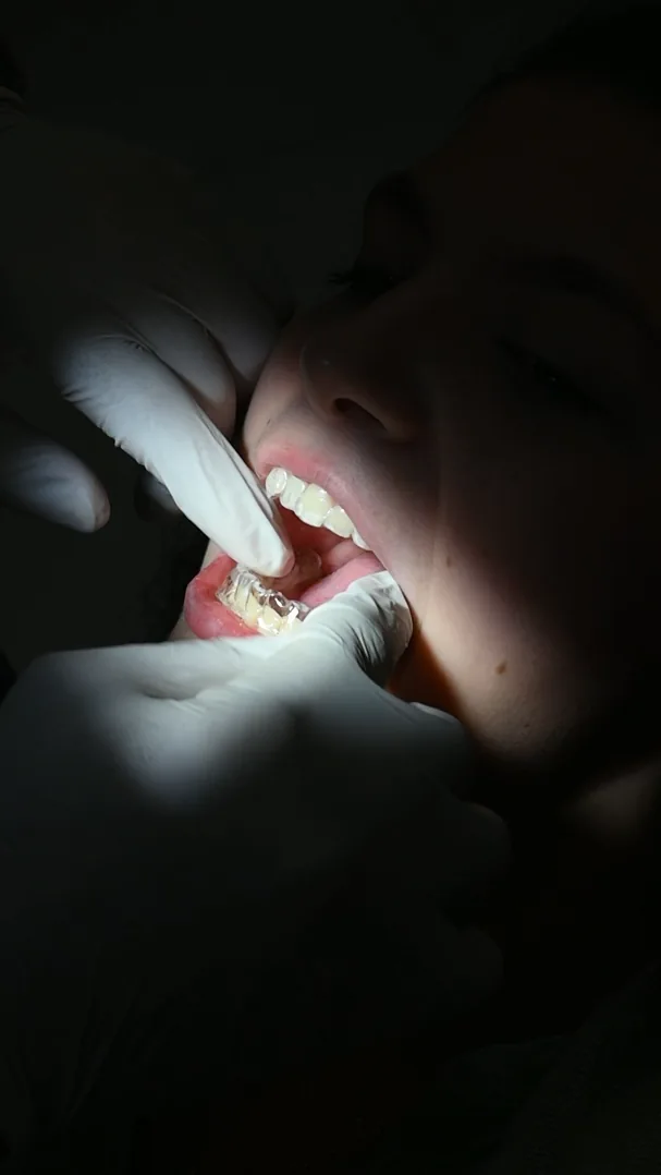 Gloved hands fitting a clear aligner tray onto a patient's lower teeth