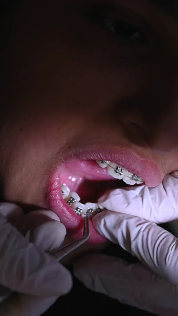 Gloved hands using orthodontic tweezers on the metal braces of a patient's lower teeth