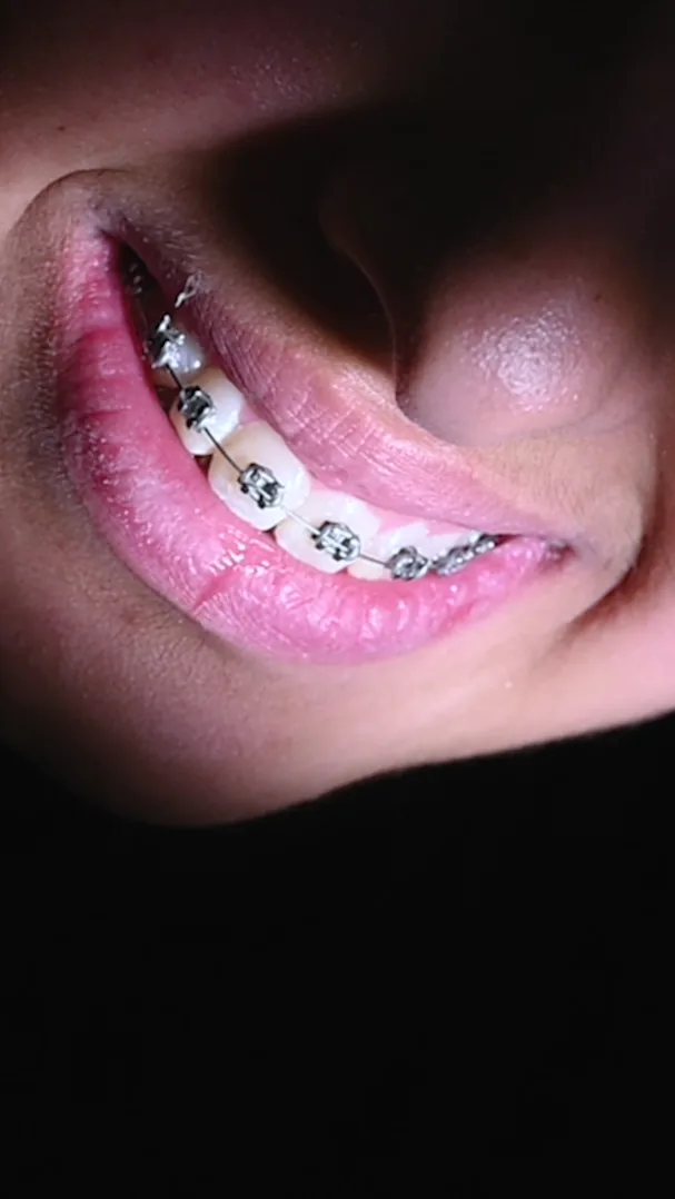 Close-up of metal brackets and an archwire on a patient's upper teeth