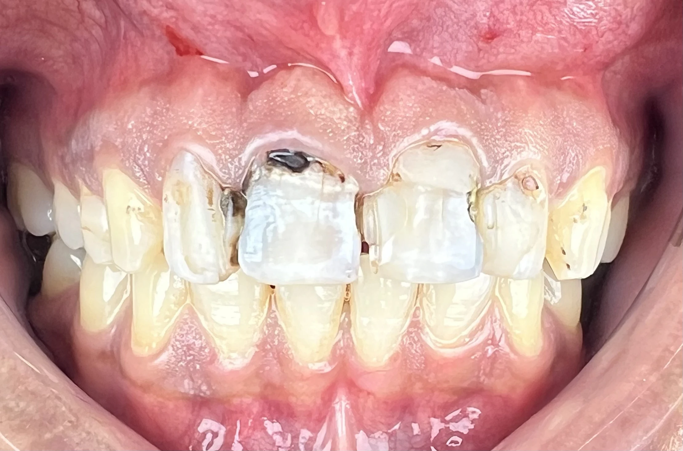 Crown & Bridge before treatment