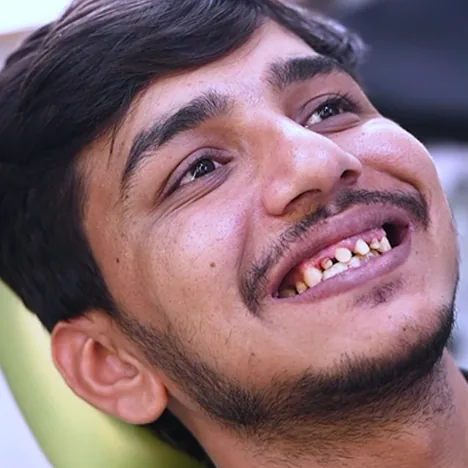 Before crown and bridge treatment: a young man smiling with broken, gapped upper front teeth