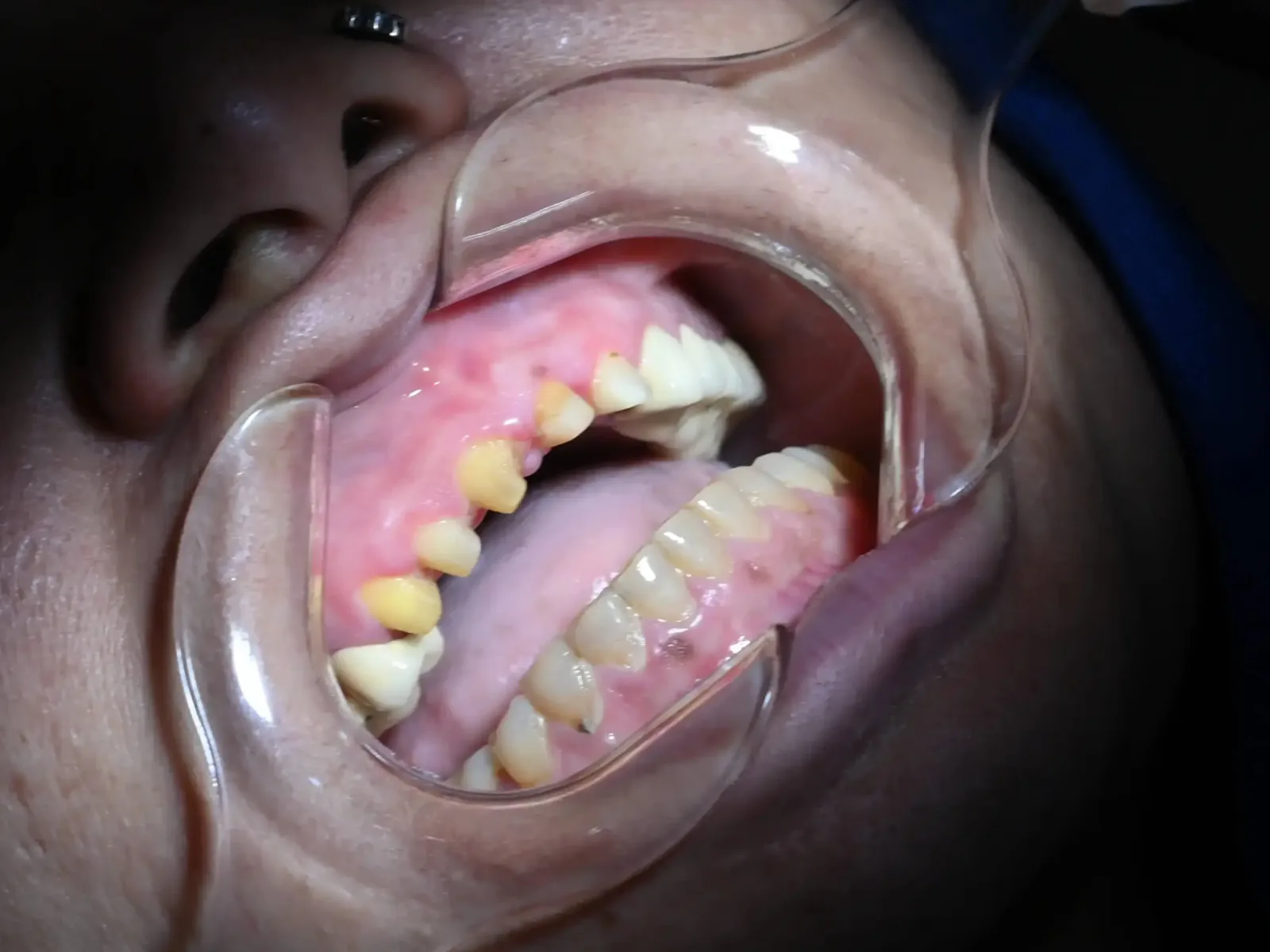 Crown & Bridge before treatment