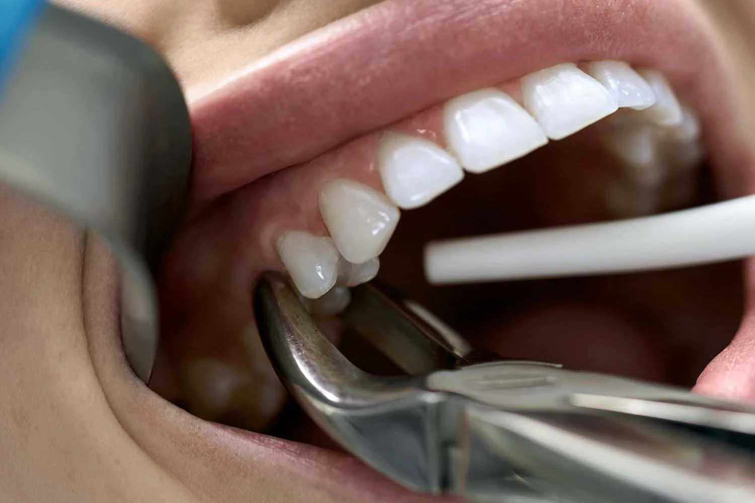 The tooth extraction process